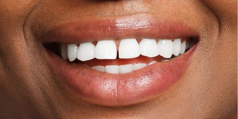 choosing between porcelain crowns and veneers