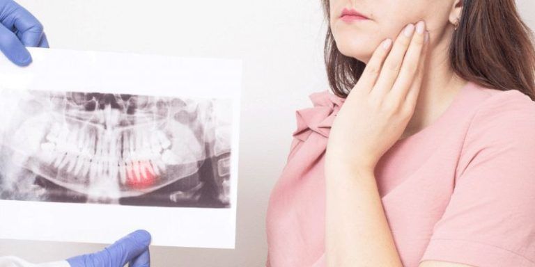 wisdom tooth extraction in Waterdown