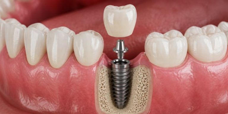 emergency dental implant for missing tooth